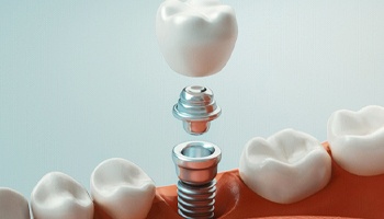 A digital image shows a dental implant, metal abutment, and customized dental crown being placed on the lower arch of the mouth