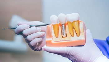 A dental professional holds a cross-section mold of the mouth that houses a single tooth dental implant between two healthy teeth