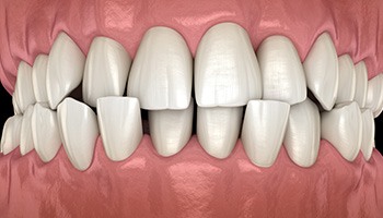 Illustration of a crossbite