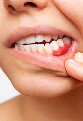 Woman pulling back her lip to reveal bleeding gums