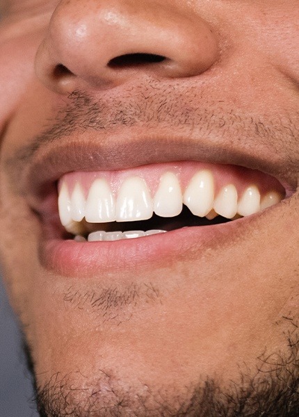 Closeup of smile after gum recontouring