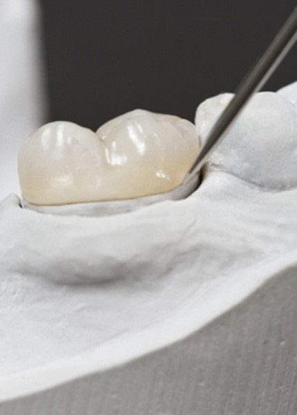 dental crown on a model of a patient’s mouth