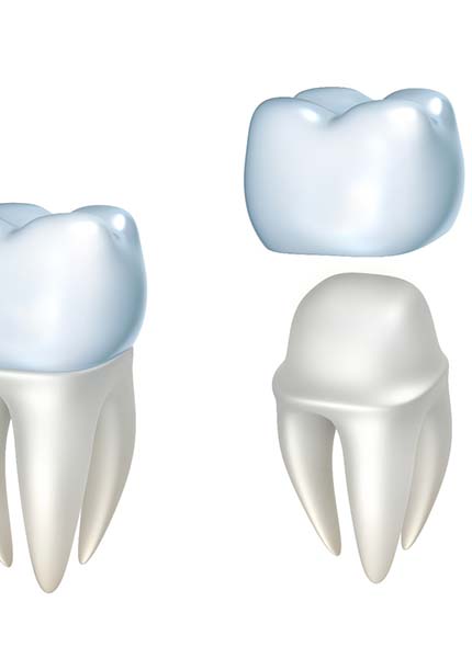 Model of an all-ceramic dental crown