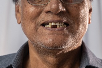 A closeup of a mouth with missing teeth