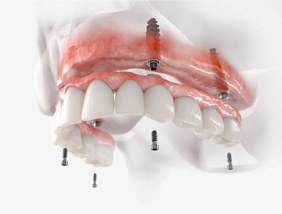 Implant dentures for upper dental arch