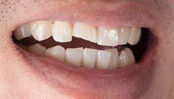Smile with chipped front tooth