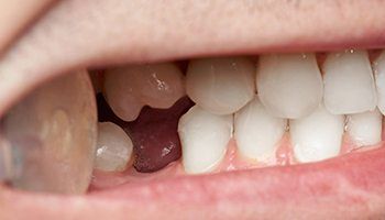 Smile with knocked out bottom tooth