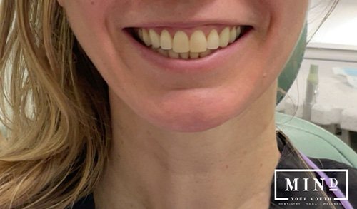 Smile gallery after image for veneers