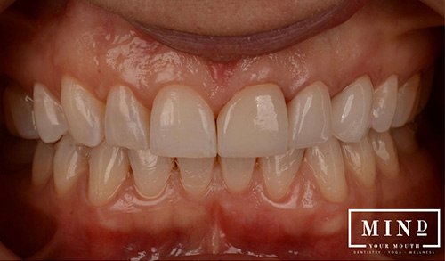 Smile gallery after image for veneers