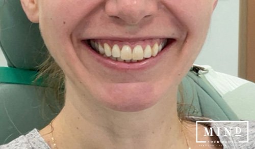Smile gallery before image for veneers