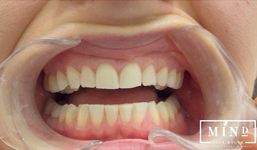 Smile gallery before image for veneers