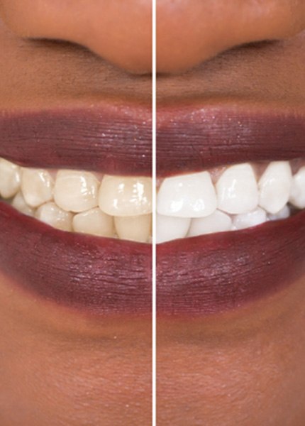 close-up of a woman before & after teeth whitening 
