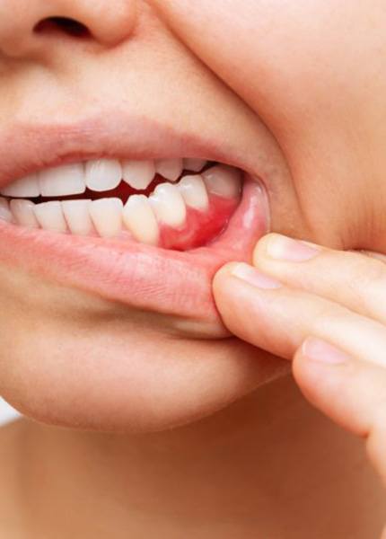 Woman pulling back her lips to reveal bleeding gums