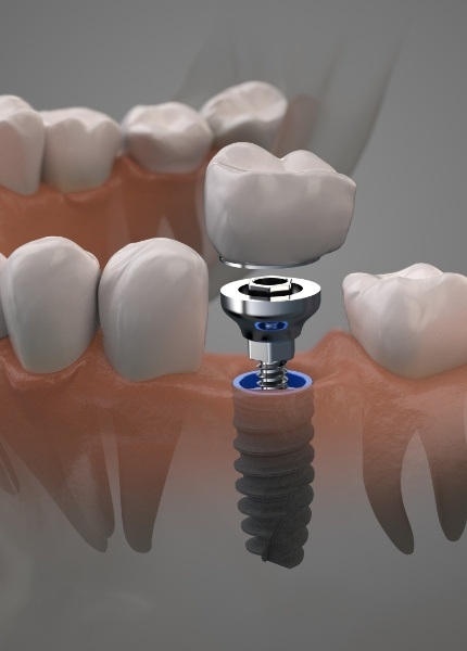 Animated dental implant supported dental crown placement