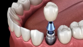 Animated dental implant supported dental crown placement