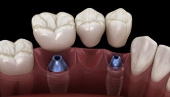 Animated dental implant supported fixed bridge placement