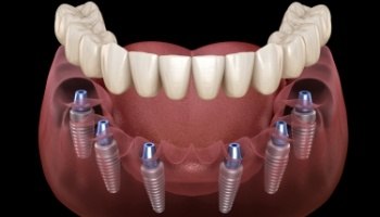 Animated dental implant supported denture placement