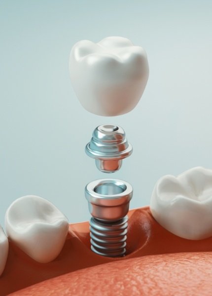 Animated parts of a dental implant replacement tooth