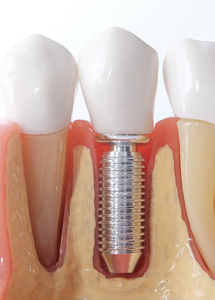 A model of a jaw with a dental implant