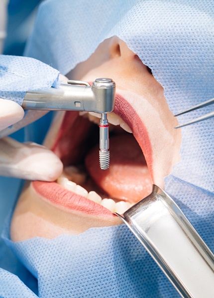 A dentist attaching a dental implant 