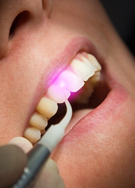 Patient receiving soft tissue laser dentistry treatment