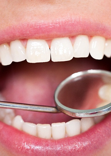 Dental mirror showing patient's tooth-colored filling