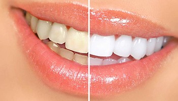 a before/after image of teeth that have undergone whitening treatment
