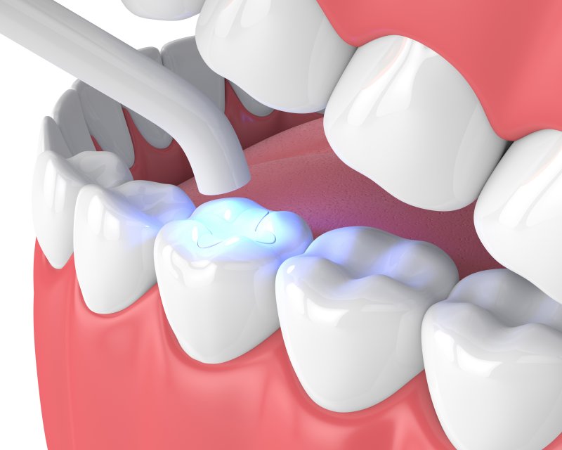 a digital image of a dental filling found in a tooth on the lower arch of the mouth  