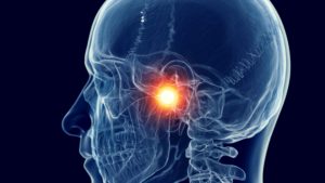 X-ray image of a skull with the temporomandibular joint glowing yellow