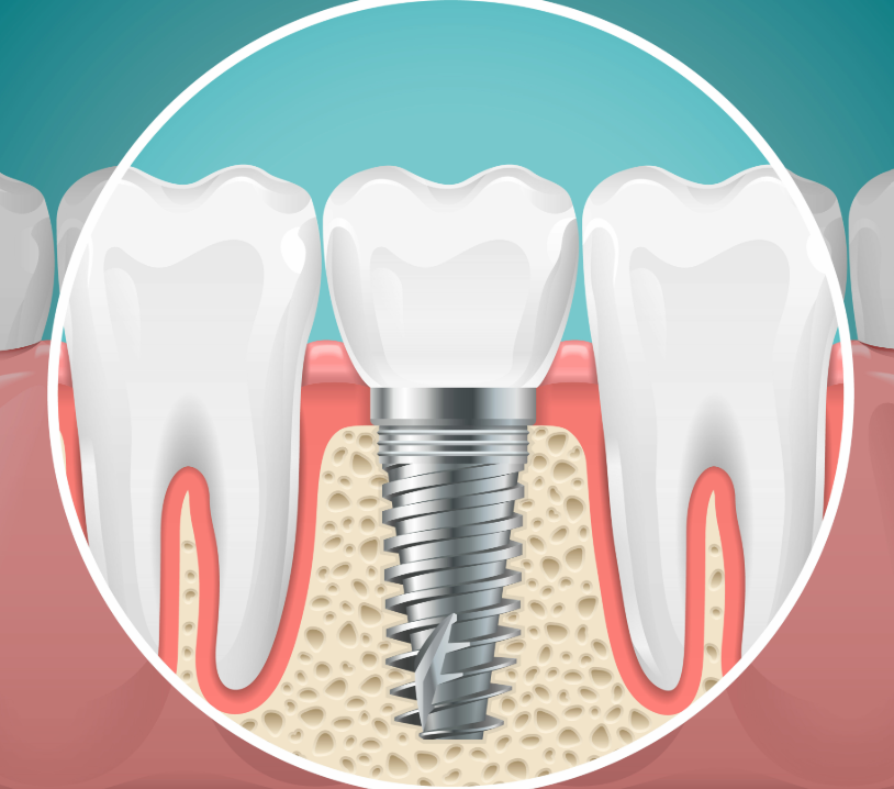 Illustrated cross-section of a dental implant